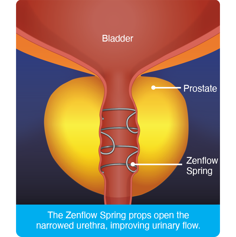 Zenflow Springs props open a narrowed urethra